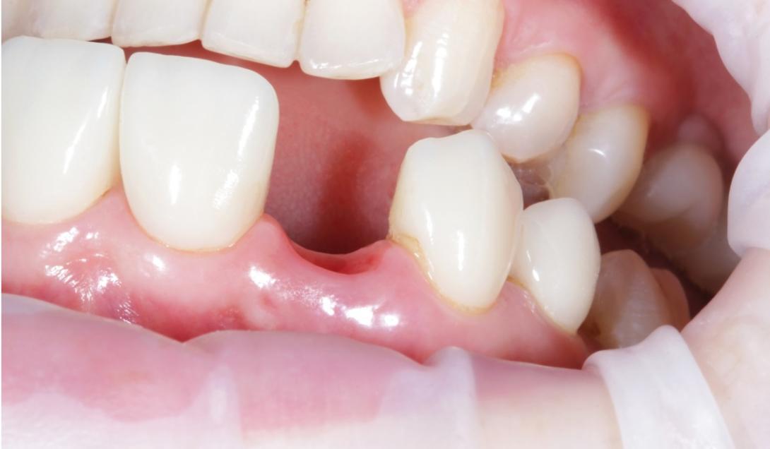 Adiós implantes: ensayan un fármaco que regenera los dientes caídos-0